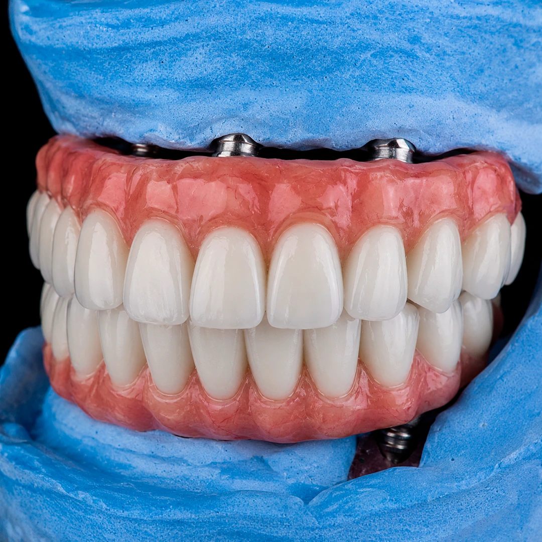 Tratamento com implantes e prótese protocolo